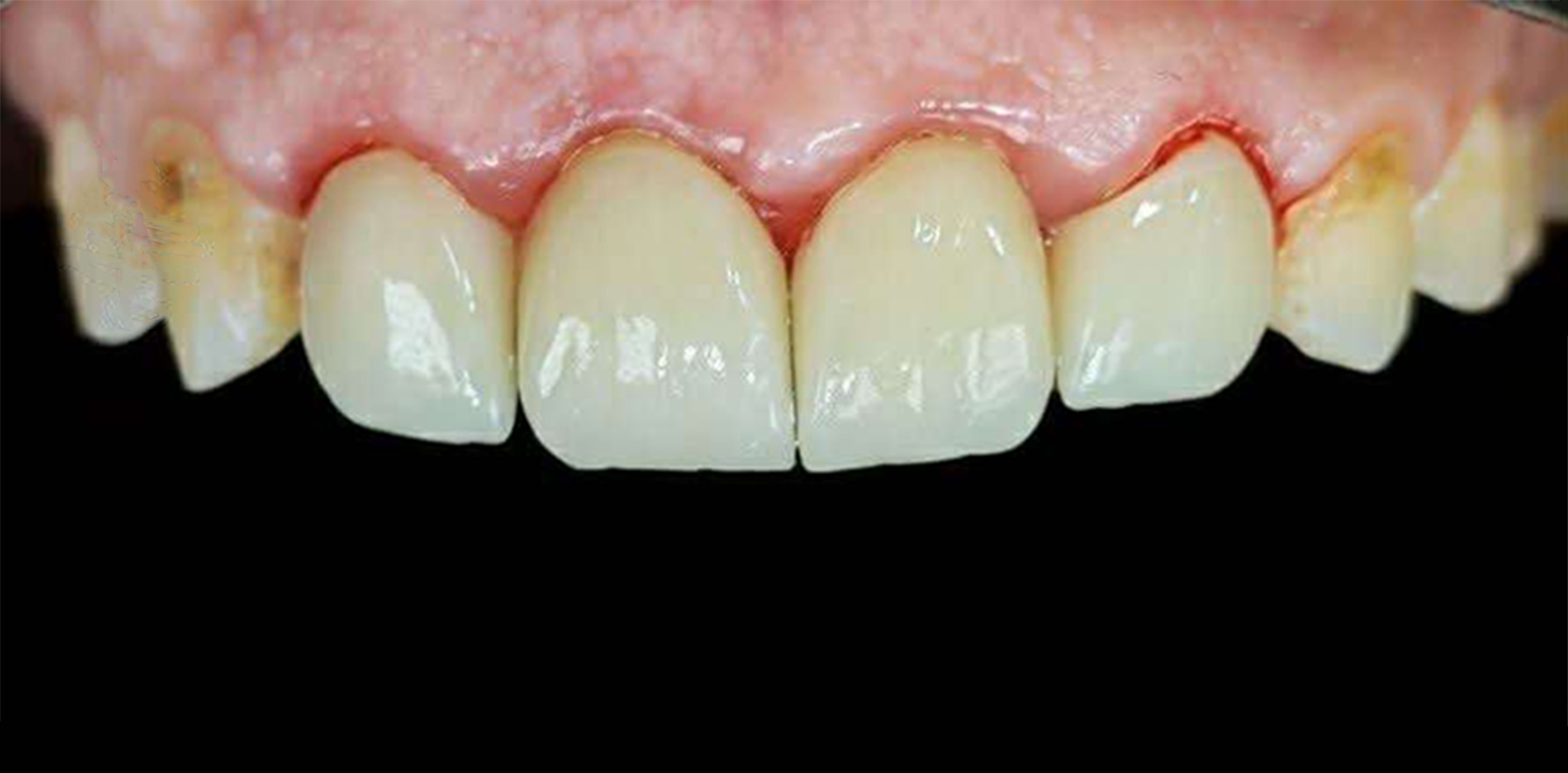 بعد — تركيبات زيركون لتجميل الابتسامة